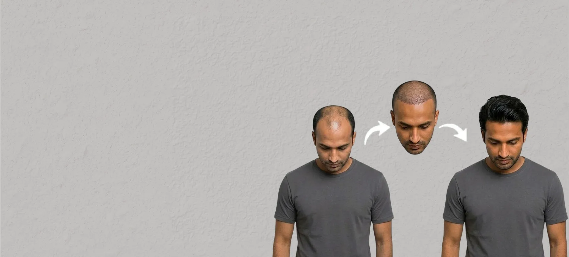Hair Transplant Clinic